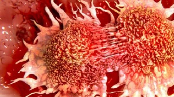 incredibil a fost inventat un aparat care depisteaza cancerul prin simpla analiza a respiratiei mai usor nu se poate