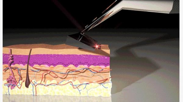 video barbatii ar putea scapa de neplacerile barbieritului