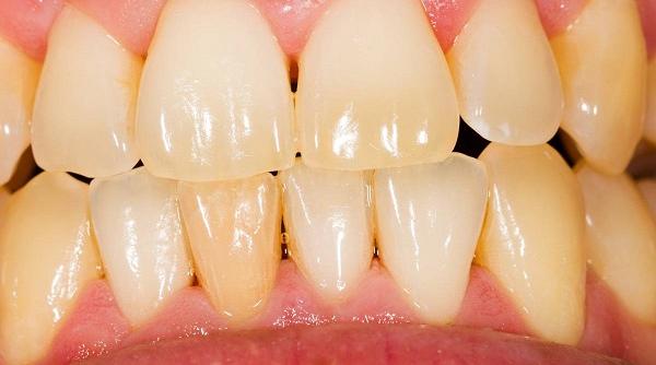 6 remedii naturiste care pot tine paradontoza sub control