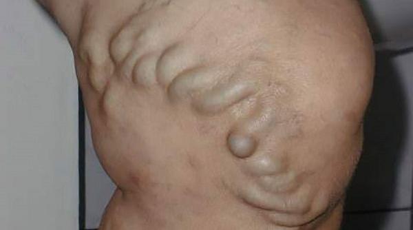 3 uleiuri esentiale care te scapa de varice