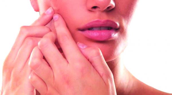 sfatul medicului cum ne ferim de acnee