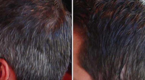 descopera metoda revolutionara care te scapa de parul carunt