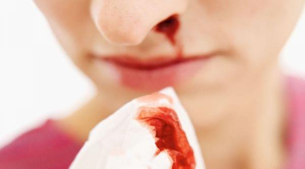 cauze si tratament pentru sangerarea nazala