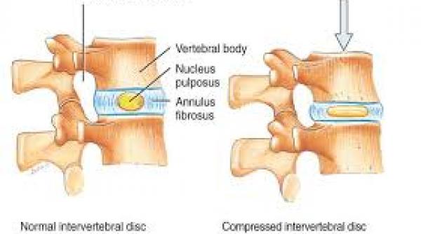 vesti bune pentru cei care sufera de hernie de disc au fost create celule susa pentru repararea discurilor intervertebrale