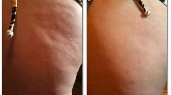 cel mai eficient tratament anti celulitic se prepara acasa iata despre ce este vorba