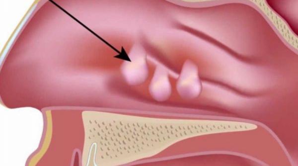 tot ce trebuie sa stii despre polipi sau vegetatiile adenoide