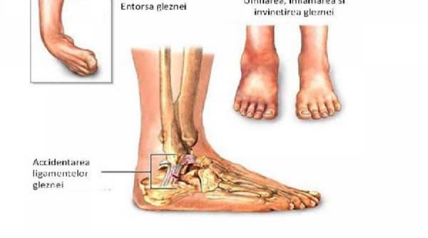 entorsa intinderea cauze tratament