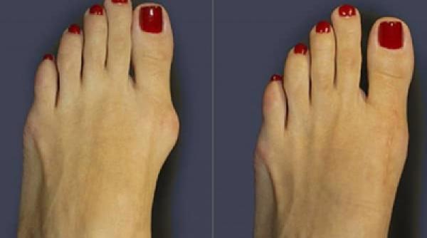 solutii alternative pentru a scapa de durerile provocate de monturi