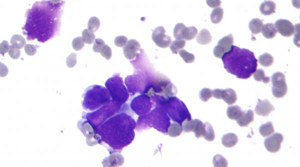 stresul cronic un factor important al raspandirii cancerului