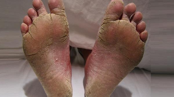 tratamente naturiste sanatatea picioarelor cu ajutorul produselor casnice de zi cu zi