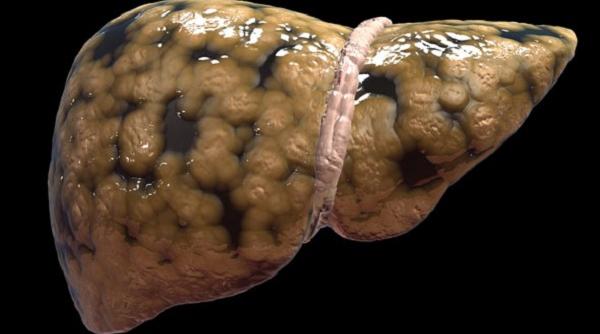 tratamente naturiste reteta zerului de casa care detoxifiaza ficatul gras