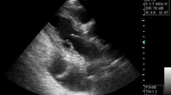 statul american indiana interzice avortul daca fatul are dizabilitati