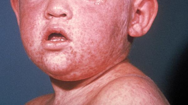 focar de rujeola in judetele bistrita si cluj