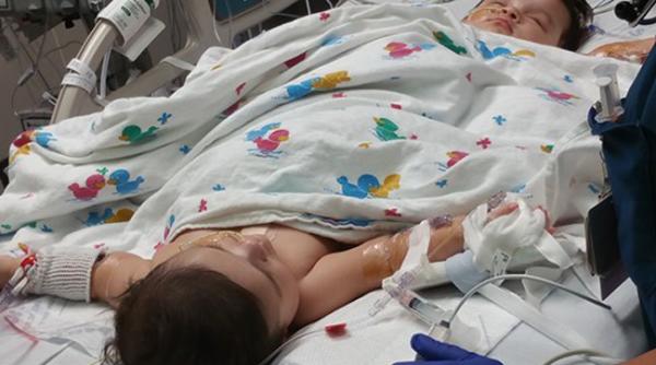 doua siameze au fost separate cu succes in texas