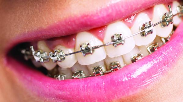 te doare capul s ar putea sa fie de la dinti