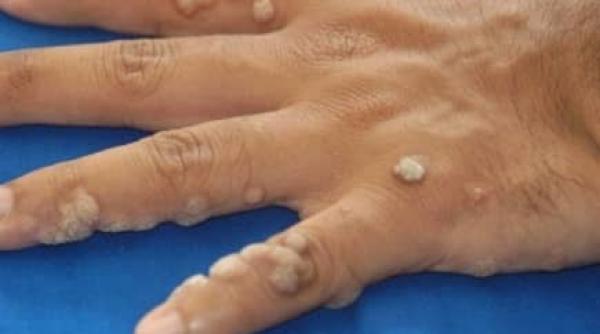 tratamente naturiste leacul pentru extirparea negilor