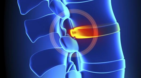 discopatia lombara cum o recunosti cum o tratezi tratamente naturiste