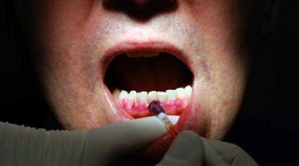 tratamente naturiste 6 remedii miraculoase care pot sa tina paradontoza sub control