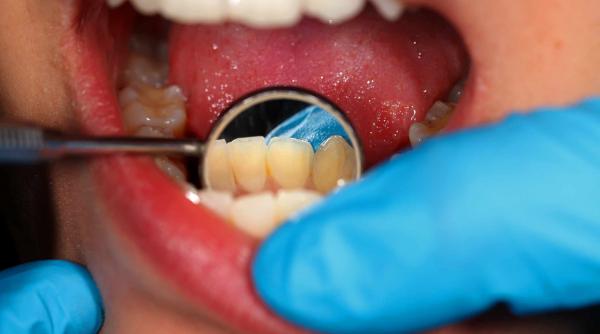 sfatul medicului cum recunosti si tratezi un abces dentar