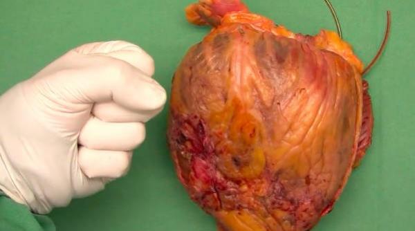 sfatul medicului tot ce trebuie sa stii despre cardiomiopatie cauze diagnostic tratament video