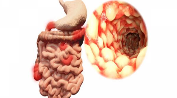 sfatul medicului totul despre boala crohn cauze diagnostic tratament terapie naturista