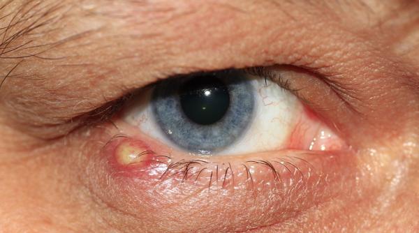 niciodata nu stoarceti ulciorul de la ochi