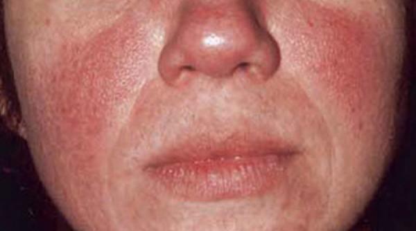 sfatul medicului rozaceea tot ce trebuie sa stii despre cauze diagnostic tratament