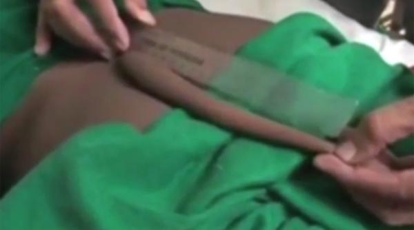 video neurochirurgii indieni au trebuit sa extirpe cea mai lunga coada a unui om