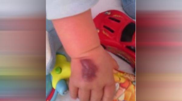 alba bebelus cu grave leziuni la o mana din cauza unei branule gresit puse