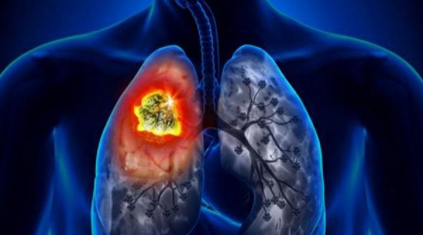 sfatul medicului totul despre cancerul pulmonar cauze diagnostic tratament
