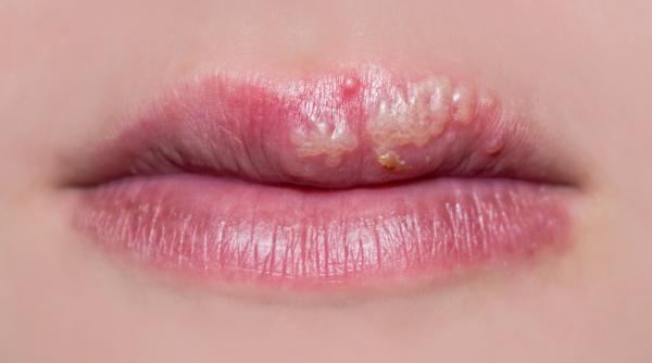 herpesul cum il tratezi remedii clasice si naturiste