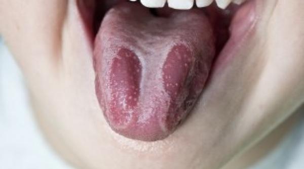 sfatul medicului tot ce trebuie sa stii despre candidoza cauze diagnostic tratament