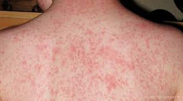 care sunt complicatiile rujeolei