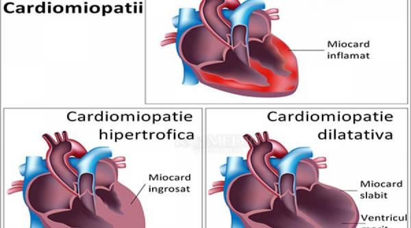 totul despre cardiomiopatie forme cauze simptome tratamente traditionale