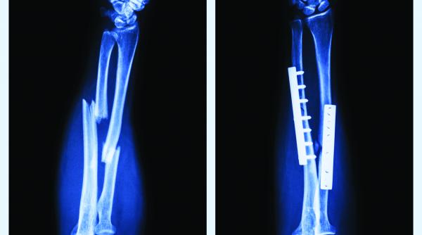 medic nu lasati oasele sa se leneveasca