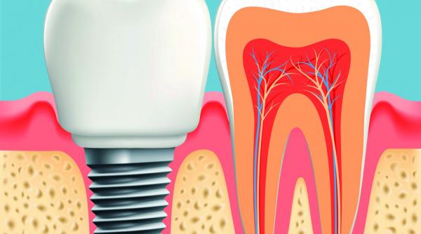 implantul dentar implica multe vizite la medic si o igiena bucala ireprosabila