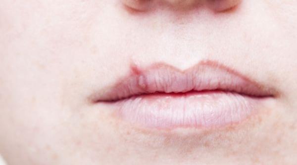 herpesul oral ce il activeaza si cum il tratam fara medicamente