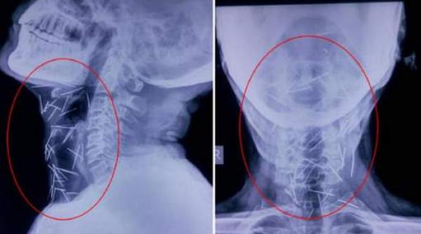ce au descoperit medicii dupa ce au facut o radiografie unui pacient