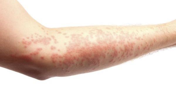 tratamente naturiste zona zoster cele mai bune terapii pe care le ofera natura