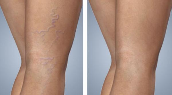 tratamente naturiste pentru varice