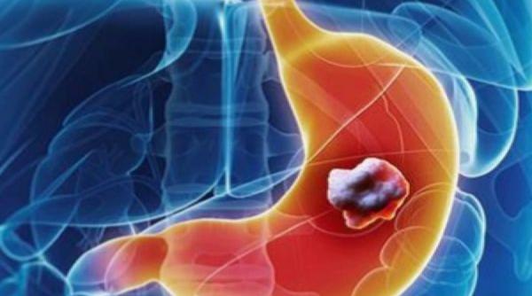 alimentul nebanuit care poate incetini dezvoltarea cancerului de stomac