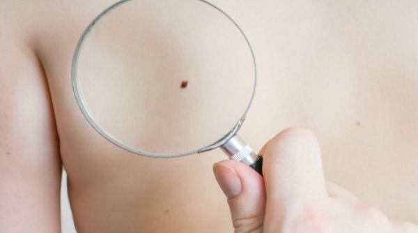 simptomele cancerului de piele ce trebuie sa stiti