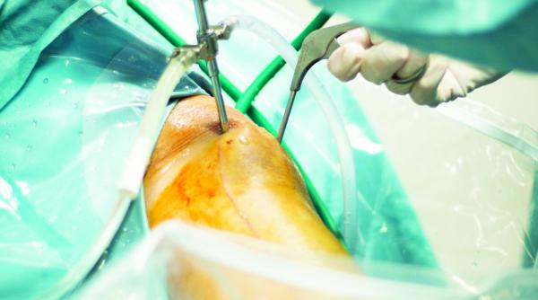 indepartarea meniscului aduce mai devreme artroza solutia este artroscopia