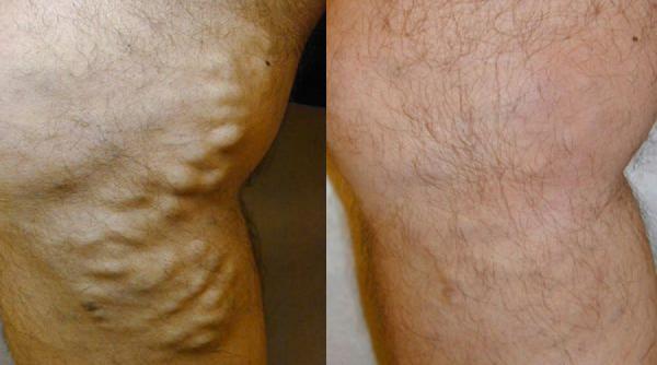 varicele cauze simptome si tratament