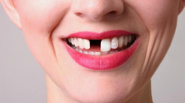 aceste greseli iti distrug dantura iata de ce trebuie sa tii cont