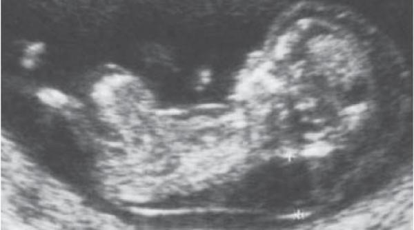 caz exceptional in franta un fetus si a salvat viata si pe cea a mamei in urma unei rupturi uterine