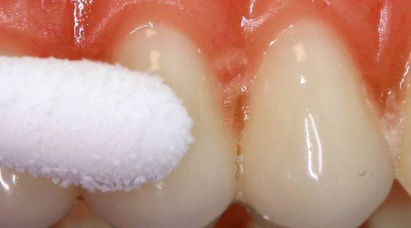 tratamente naturiste cum sa scapi de gingivita cu ajutorul remediilor naturale