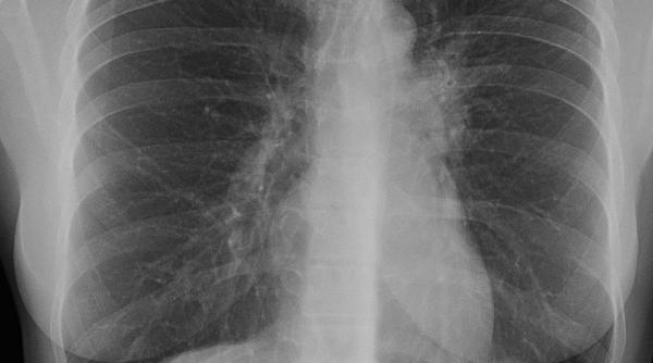 teleorman 12 cazuri de tbc la scoala mihai eminescu