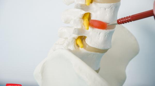 munca la calculator si hernia de disc cervical