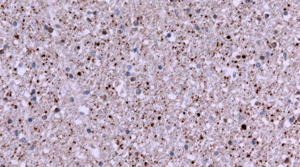 primul medicament care incetineste boala huntington